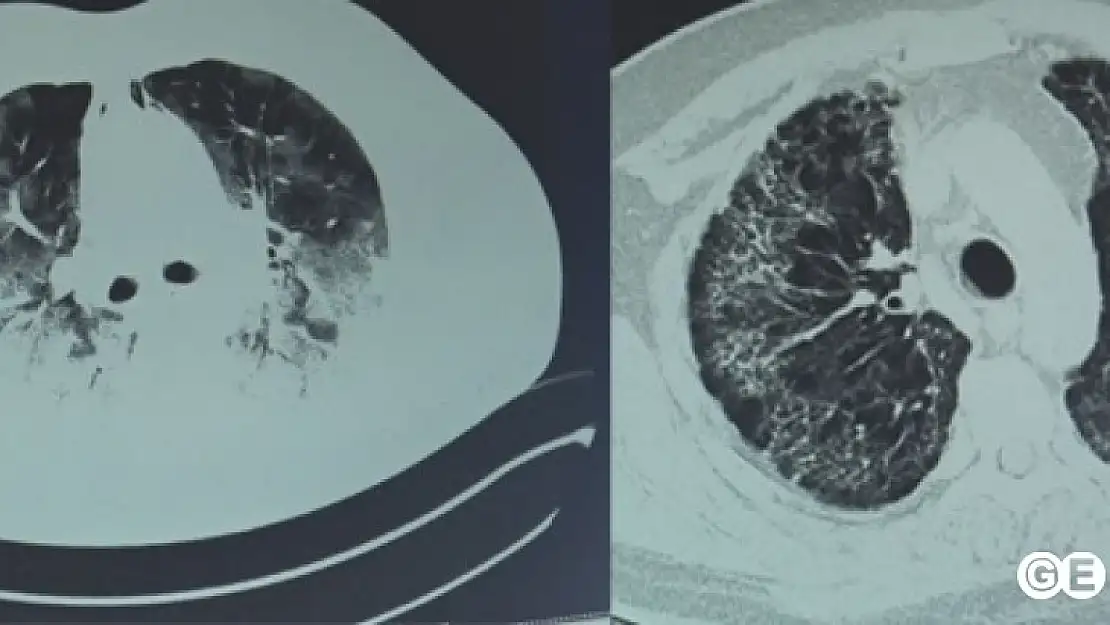 Koronavirüs akciğerinin yüzde 80'ini kaplamıştı ozon tedavisiyle hayata döndü